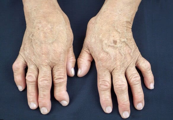 soda u liječenju artritisa